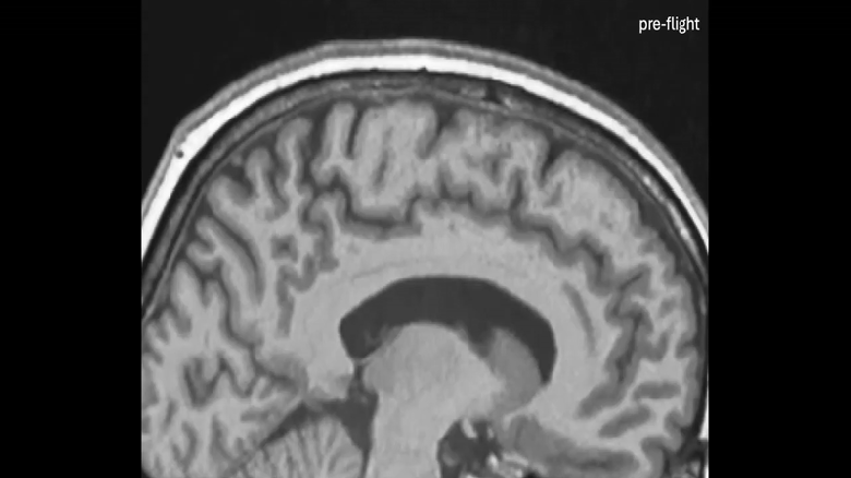 Микрогравитация меняет форму мозга астронавтов: зафиксированы смещение, растяжение и сжатие